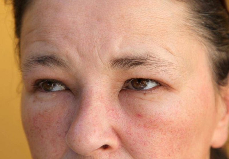 Closeup-of-woman-suffering-from-allergies